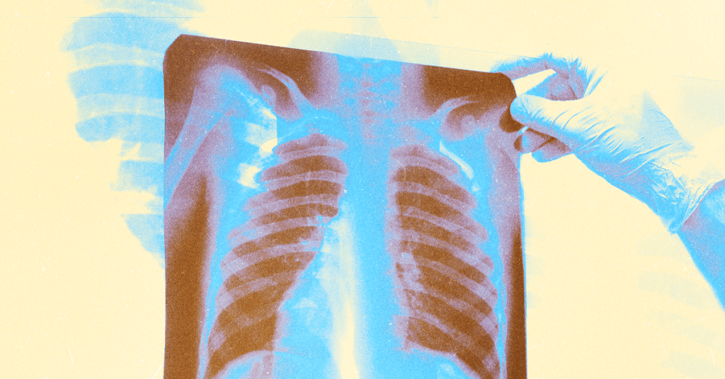 Terminated: St. Francis fires neurosurgery tech waiting for lung transplant